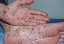 Crecen en forma alarmante los casos de sífilis entre adolescentes